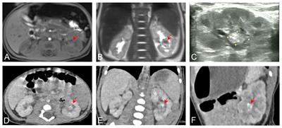 Ossifying renal tumor of infancy: a case report